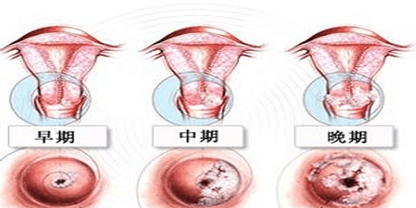 如何预防早期宫颈癌