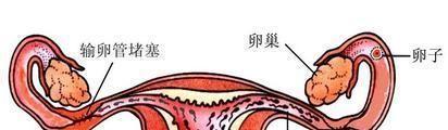 输卵管疾病导致女性不孕的5大因素-汇总分享