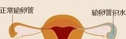 输卵管疾病导致女性不孕的5大因素-汇总分享