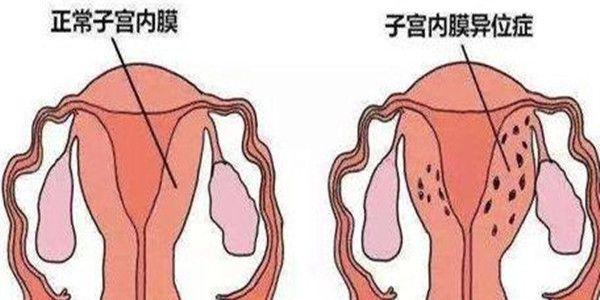 什么是子宫内膜异位症，子宫内膜异位症怎么治疗