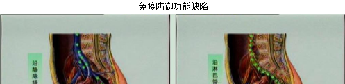 动漫解析子宫内膜异位症是如何形成的