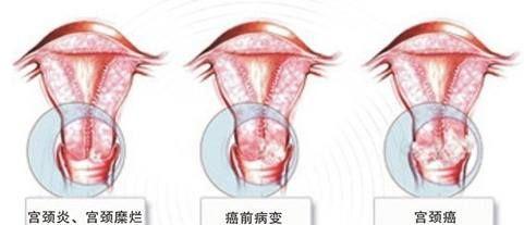 专家浅谈宫颈炎对女性的影响及危害