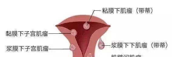 子宫肌瘤会导致不孕的6种情况汇总