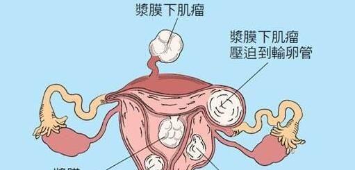 子宫肌瘤会导致不孕的6种情况汇总