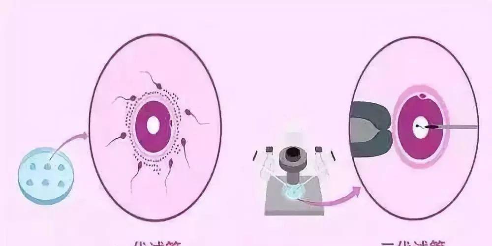 第一、二代试管婴儿分别适合哪些不孕人群-专家解答