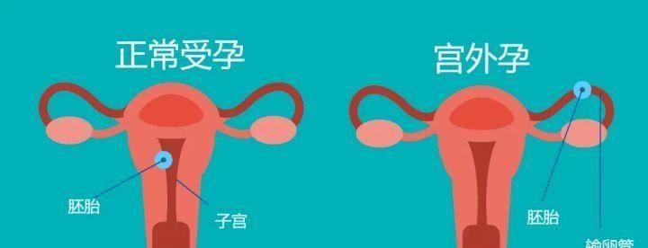 宫外孕图