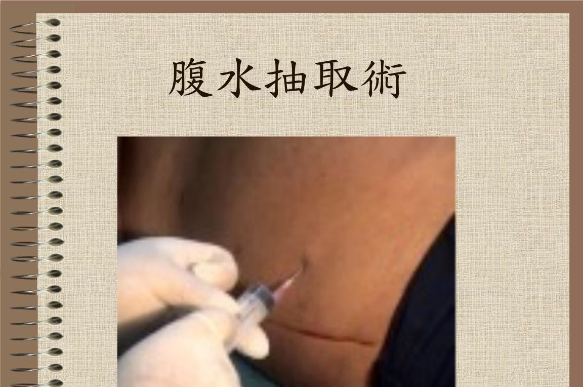 试管婴儿取卵后腹水怎么办？程度不同治疗方式不同