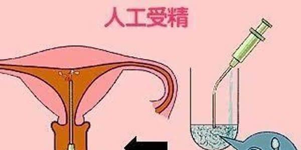人工受精的流程及费用