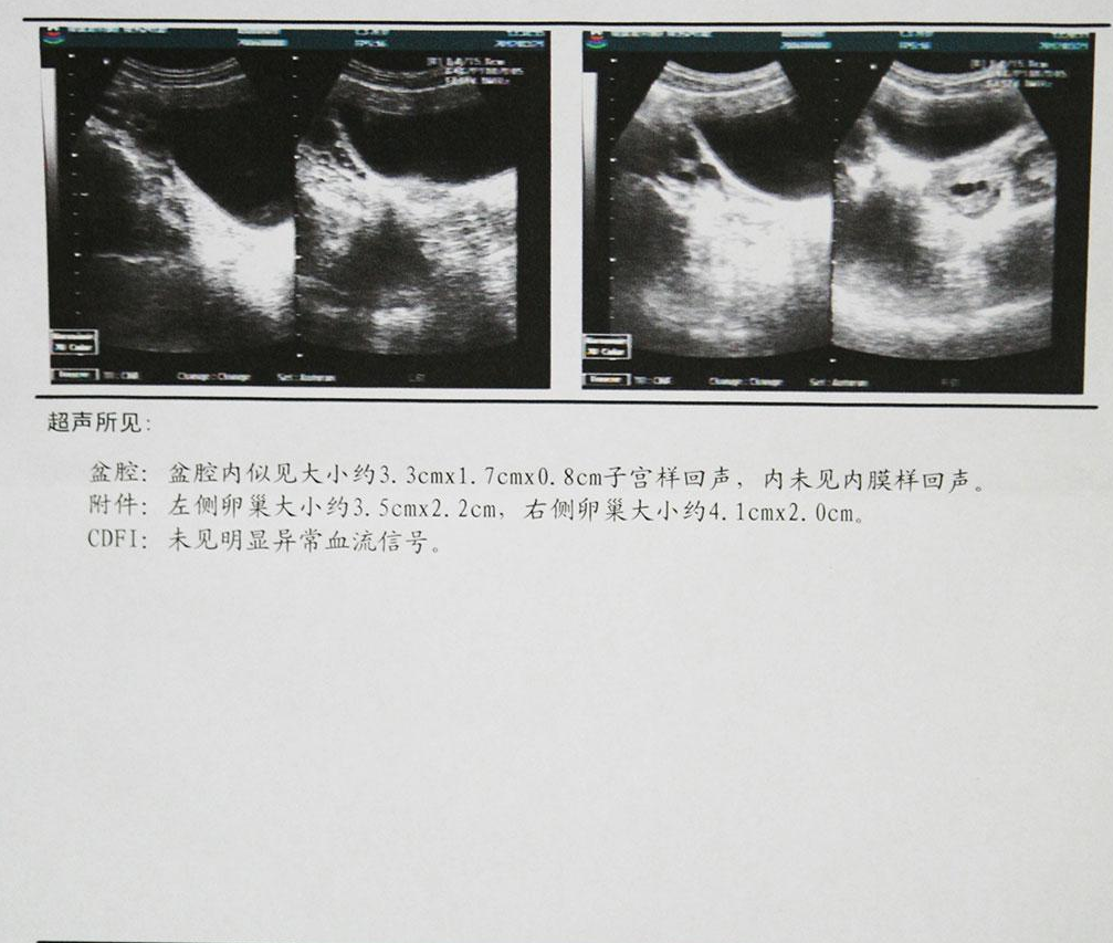 关于始基子宫的这些你要知道-成因，症状，治疗g