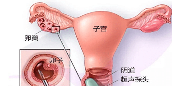 试管长方案和短方案的区别优缺点