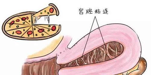 什么是宫腔粘连，宫腔粘连影响怀孕吗？