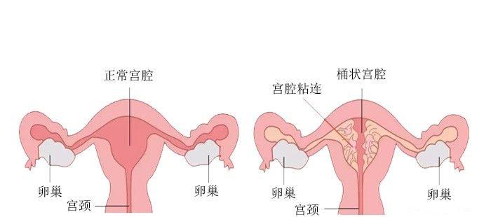 宫腔粘连的两大危害不仅影响月经还会影响生育！