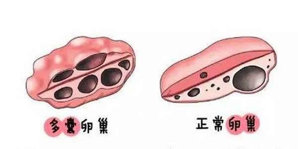 卵巢多囊综合征的症状有哪些