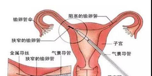 我结婚2年，输卵管一边堵塞能怀孕吗？