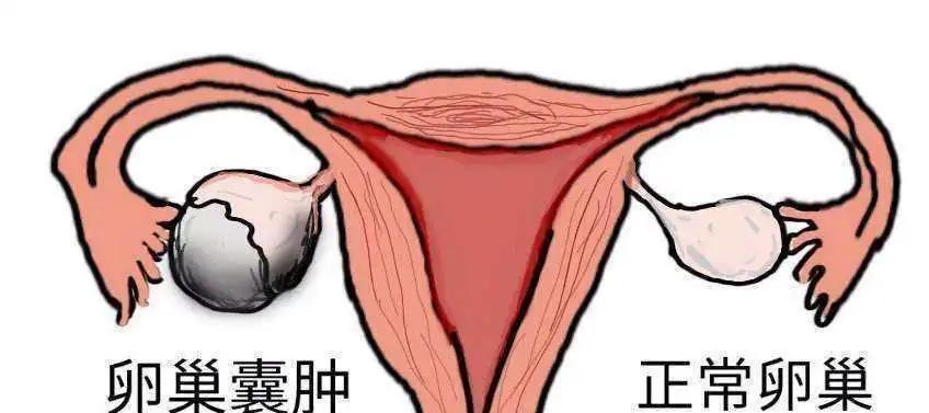 卵巢囊肿