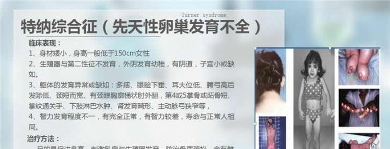 特纳氏综合征图片