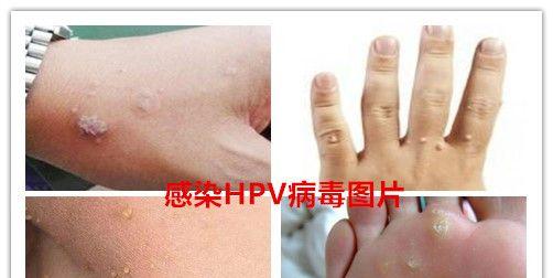 HPV病毒感染的症状图片