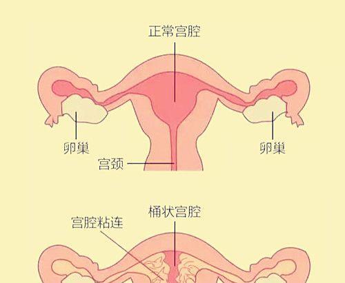 宫腔粘连医学图解
