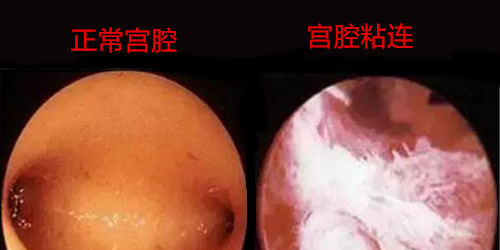 宫腔粘连医学图解