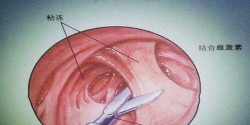 宫腔粘连医学图解