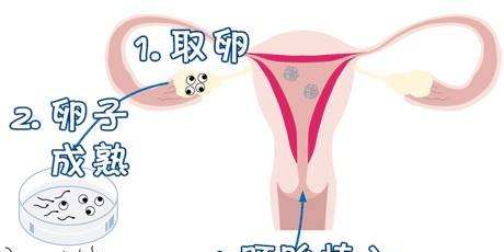 试管婴儿