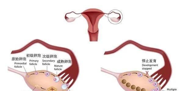 多囊卵巢治疗后基本都能受孕！