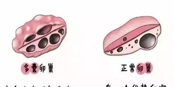 多囊卵巢治疗后基本都能受孕！