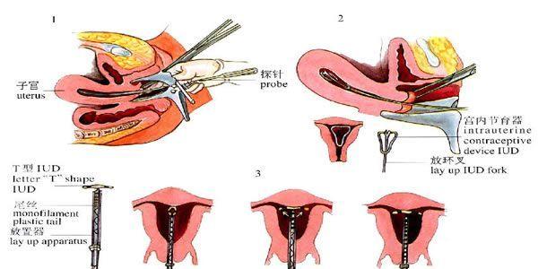 节育器有几种附图片-节育环种类介绍