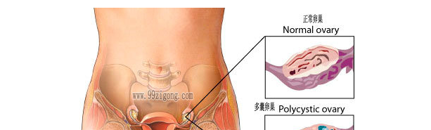 多囊卵巢综合征图