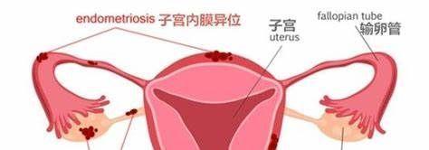 子宫内膜异位症
