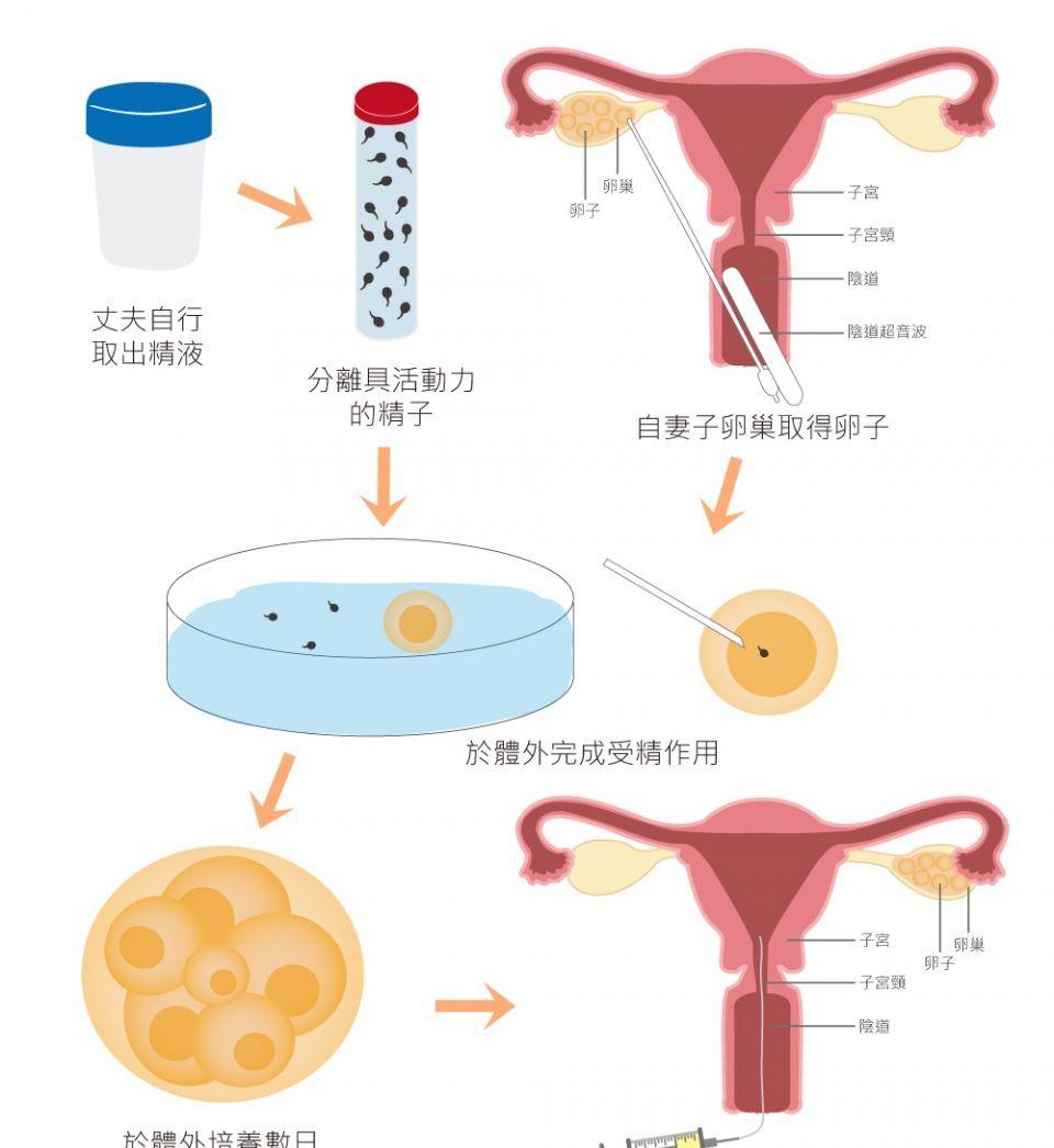 试管婴儿流程图