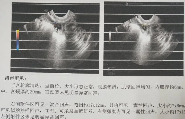 宫外孕超声诊断单