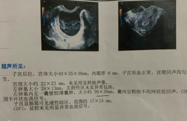 卵巢囊肿开腹手术恢复时间长