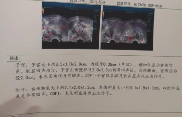 残角子宫怀孕后宫腔破裂风险大