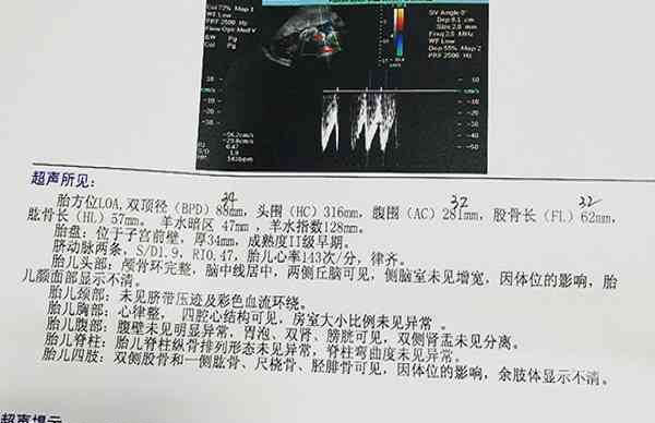 双顶径在10cm以下可以顺产