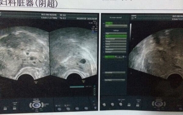 前列腺素会影响排卵