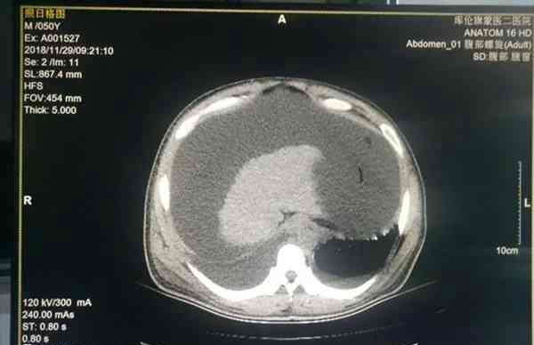 nt检查准确率并不高