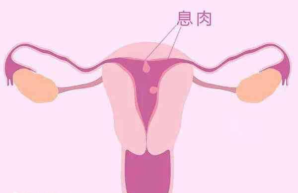 子宫内膜息肉通常与雌孕激素有关