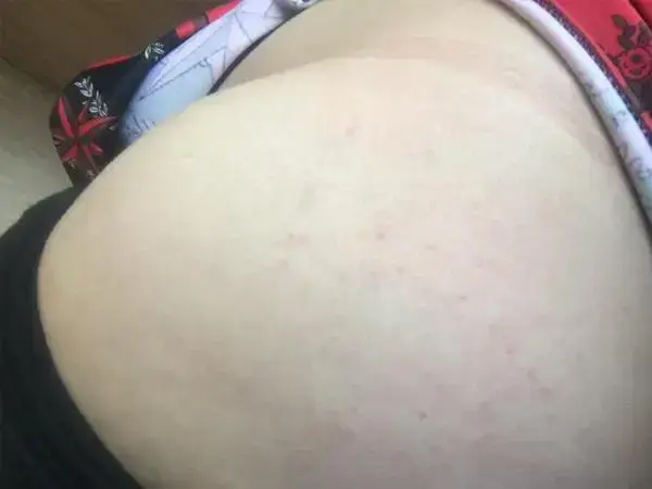 肥胖会增加妊娠纹产生的机会