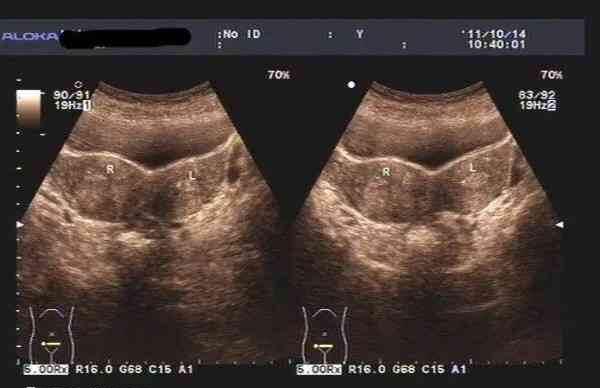已经怀孕的女性不要轻易做阴道超声
