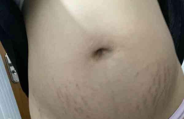 大多数孕妇的妊娠纹长在肚皮上