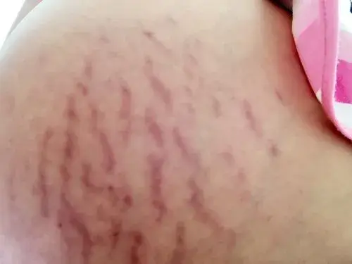 妊娠纹是迅速发胖引起的