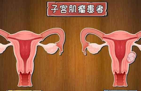 绝经以后肌瘤会逐渐缩小