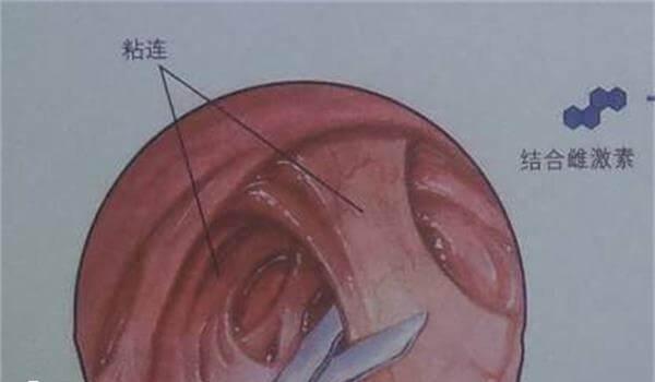 粘连的子宫腔只能容纳较小的胎儿
