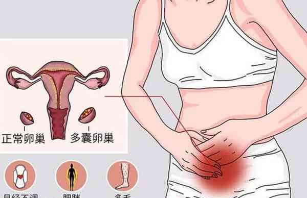 多囊卵巢综合症会导致囊胚停止发育