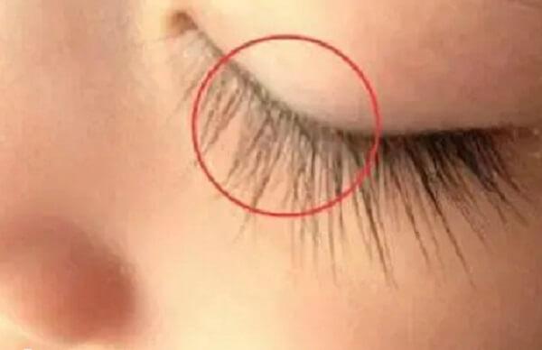 倒睫主要是睫毛的生长方向发生异常