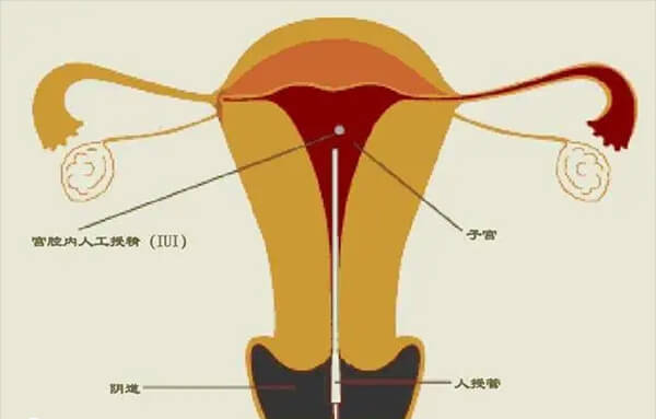 人工授精手术