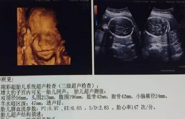 孕囊大小的长和宽的相差在一倍以上怀男宝宝可能性大
