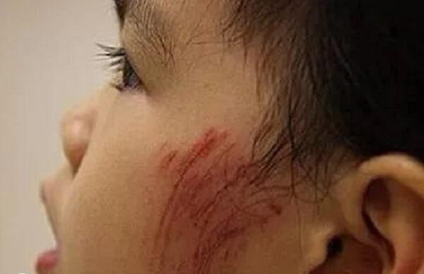 宝宝不小心被划伤家长一定要及时给宝宝消毒