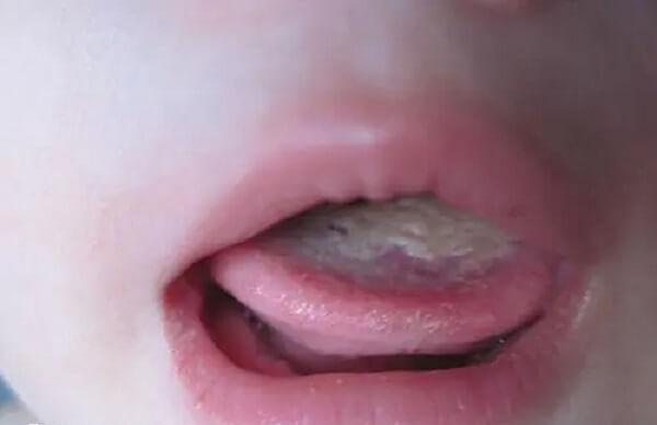 鹅口疮经常在口腔不清洁的婴儿中发病